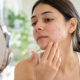 Acne Marks or Acne Scars